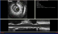 IVUS Enhancer