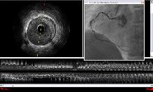 IVUS Enhancer